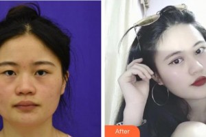 桂林市中醫(yī)醫(yī)院眼科李民堅(jiān)整形價(jià)格表附切開(kāi)雙眼皮案例展示