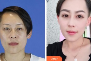 桂林市中醫(yī)醫(yī)院眼科楊小凡整形價(jià)格表附切開(kāi)雙眼皮案例展示