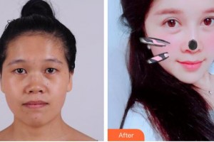 梧州市人民醫(yī)院燒傷整形科黃振強(qiáng)整形價(jià)格表附眼部綜合案例展示