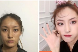 梧州市紅十字會(huì)醫(yī)院燒傷整形科陳燕圖整形價(jià)格表附定點(diǎn)雙眼皮案例展示