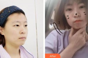 梧州市工人醫(yī)院眼科湯蘭蘭整形價(jià)格表附切開雙眼皮案例展示