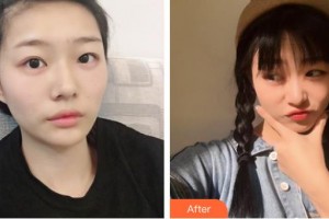 梧州市工人醫(yī)院眼科黃子伲整形價(jià)格表附眼部綜合案例展示