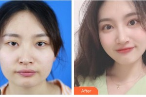 梧州市工人醫(yī)院眼科趙夏海整形價(jià)格表附切開雙眼皮案例展示