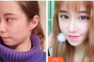 北海韓美醫(yī)療美容門診部鐘舉然整形價(jià)格表附眼部綜合案例展示