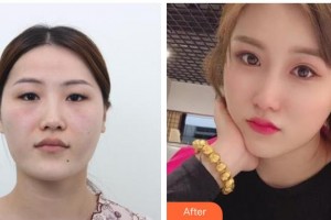 北海博鏵醫(yī)院整形美容中心余德慶整形價(jià)格表附切開(kāi)雙眼皮案例展示