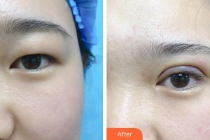 北海華美醫(yī)療美容診所郎煒慧整形價(jià)格表附眼部綜合案例展示