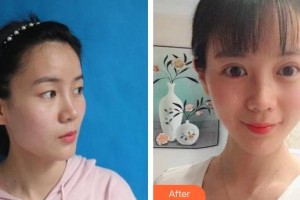 北海美秀中禾醫(yī)療美容診所常英整形價(jià)格表附切開(kāi)雙眼皮案例展示