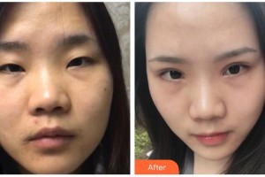 貴港市人民醫(yī)院燒傷整形外科邊建民整形價(jià)格表附眼部綜合案例展示