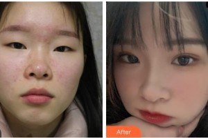 貴港愛爾眼科醫(yī)院唐健青整形價(jià)格表附眼部綜合案例展示