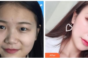 玉林愛爾眼科醫(yī)院張熙健整形價(jià)格表附眼部綜合案例展示