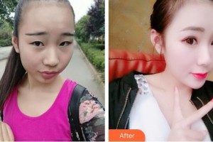 玉林時(shí)光醫(yī)療美容醫(yī)院吳克威整形價(jià)格表附定點(diǎn)雙眼皮案例展示