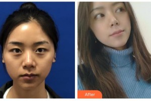 玉林愛爾眼科醫(yī)院區(qū)顯寧整形價(jià)格表附眼部綜合案例展示