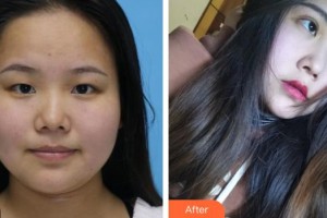 來(lái)賓市興賓區(qū)人民醫(yī)院眼科陳海軍整形價(jià)格表附眼部綜合案例展示