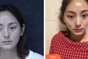 來(lái)賓市人民醫(yī)院眼科吳佳勢(shì)整形價(jià)格表附切開雙眼皮案例展示