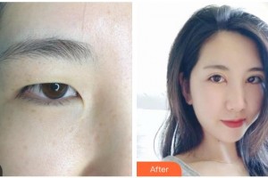 來(lái)賓市人民醫(yī)院眼科陳燕玲整形價(jià)格表附眼部綜合案例展示