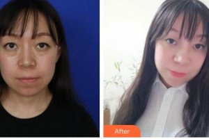 來(lái)賓市人民醫(yī)院眼科譚揚(yáng)勇整形價(jià)格表附眼部綜合案例展示