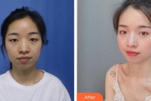 來(lái)賓市人民醫(yī)院眼科何發(fā)堅(jiān)整形價(jià)格表附眼部綜合案例展示