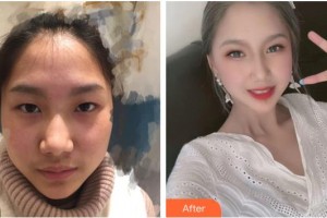 來(lái)賓市人民醫(yī)院眼科韋曉星整形價(jià)格表附眼部綜合案例展示