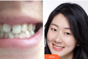 江陰艾爾美醫(yī)療美容診所張榮佑整形價(jià)格表附牙齒陶瓷矯正案例展示