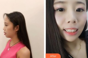 江陰牙博士口腔門(mén)診部顧冬輝整形價(jià)格表附牙齒隱形矯正案例展示