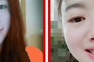 江陰牙博士口腔門(mén)診部張磊整形價(jià)格表附金屬托槽矯正案例展示