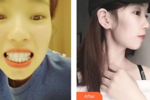 江陰艾爾美醫(yī)療美容診所張思平整形價(jià)格表附牙齒隱形矯正案例展示