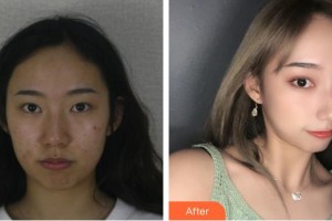 江陰光明眼科醫(yī)院卞春及整形價(jià)格表附切開雙眼皮案例展示