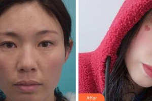 江陰艾爾美醫(yī)療美容診所吳聃整形價(jià)格表附切開(kāi)雙眼皮案例展示