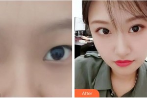 江陰市中醫(yī)院整形美容科陳偉中整形價(jià)格表附切開(kāi)雙眼皮案例展示