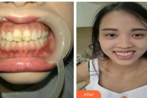 江陰牙博士口腔門(mén)診部裴洪來(lái)整形價(jià)格表附美白貼片案例展示