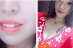 江陰牙博士口腔門(mén)診部張瑞杰整形價(jià)格表附牙齒隱形矯正案例展示