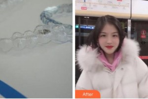 江陰牙博士口腔門(mén)診部林曉整形價(jià)格表附牙齒隱形矯正案例展示