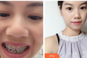 江陰牙博士口腔門(mén)診部范坤鵬整形價(jià)格表附金屬托槽矯正案例展示