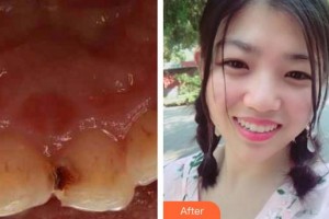 江陰牙博士口腔門(mén)診部宋旭杰整形價(jià)格表附美容冠案例展示