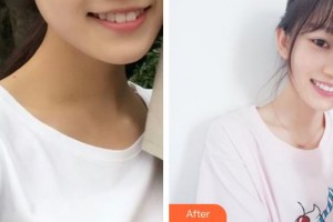 江陰金誠(chéng)口腔門(mén)診部包崇云整形價(jià)格表附牙貼面案例展示