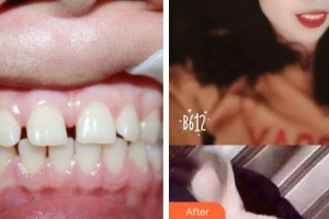 江陰金誠(chéng)口腔門(mén)診部張曉瑩整形價(jià)格表附牙齒隱形矯正案例展示