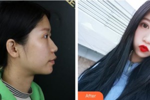 江陰光明眼科醫(yī)院汪曉倩整形價(jià)格表附切開雙眼皮案例展示