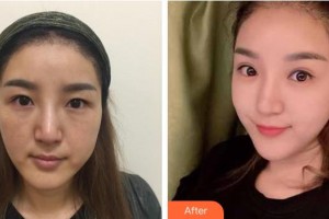 江陰光明眼科醫(yī)院劉華整形價(jià)格表附眼部修復(fù)案例展示