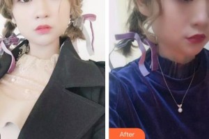 江陰光明眼科醫(yī)院陳義兵整形價(jià)格表附切開雙眼皮案例展示