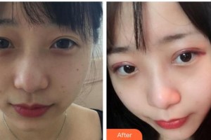 江陰光明眼科醫(yī)院石丹整形價(jià)格表附切開雙眼皮案例展示