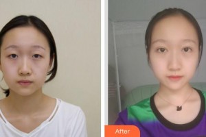 江陰光明眼科醫(yī)院陳維萍整形價(jià)格表附埋線雙眼皮案例展示