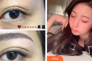 海南瑞韓醫(yī)學美容醫(yī)院徐春梅整形價格表附埋線雙眼皮案例展示