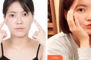 海南眼科醫(yī)院龍登虹整形價格表附開內(nèi)眼角案例展示