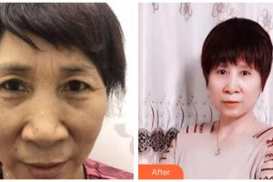 海南眼科醫(yī)院曾明兵整形價格表附切眉術案例展示