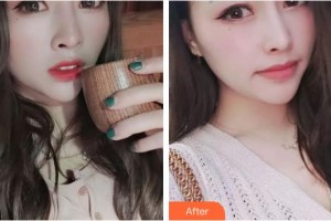 海南眼科醫(yī)院郭惠宇整形價格表附眼部綜合案例展示