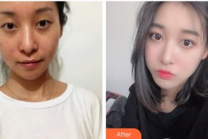 海南眼視光學中心門診部李加青整形價格表附開內(nèi)眼角案例展示