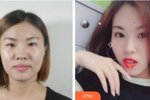 海南眼視光學中心門診部劉春民整形價格表附切開雙眼皮案例展示