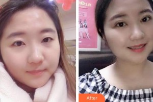 海南省中醫(yī)院眼科中心任韓整形價格表附切開雙眼皮案例展示