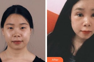 海南眼科醫(yī)院劉紅山整形價格表附眼部綜合案例展示