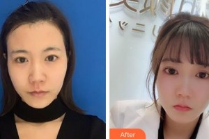 ?？跂|湖醫(yī)學(xué)美容整形醫(yī)院張文其整形價(jià)格表附去痘印痘坑案例展示